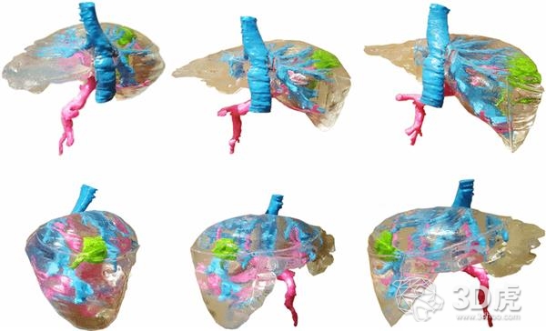 波兰研究人员借FDM 3D打印机造低成本术前肝脏模型